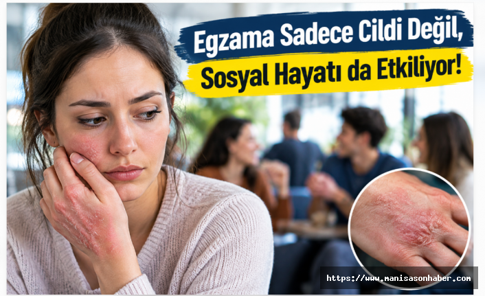 Egzama Sadece Cildi Değil, Sosyal Hayatı da Etkiliyor!