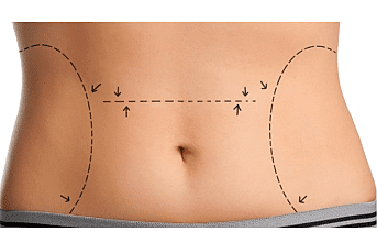 Liposuction Zayıflama Yöntemi Değildir !
