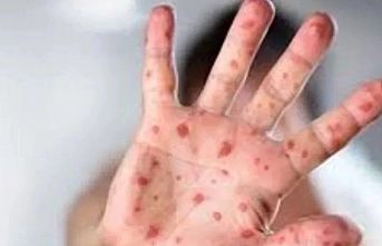 Maymun Çiçeği virüsüne karşı en dikkatli olması gereken sektör: Turizm
