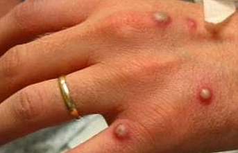 Maymun Çiçeğinde Bağışıklık Sistemi Uyarısı