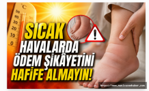 Sıcak Havalarda Ödem Şikâyetini Hafife Almayın!