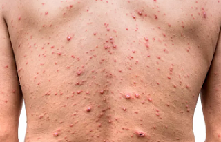 DSÖ: Maymun Çiçeği (Mpox) İçin Afrika’da Acil...