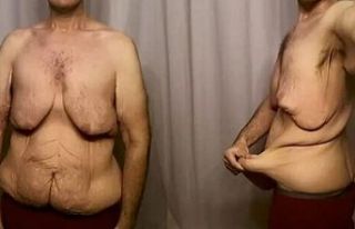 Obezite ameliyatlarından sonra oluşan deri sarkması...