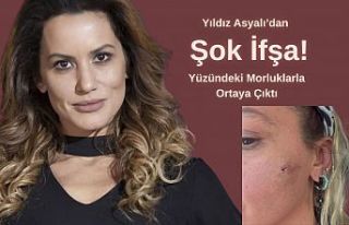 Yıldız Asyalı’dan Şok İfşa! Yüzündeki Morluklarla...