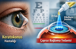 Göz Hastalıkları Uzmanı Uyardı: Keratokonusta...