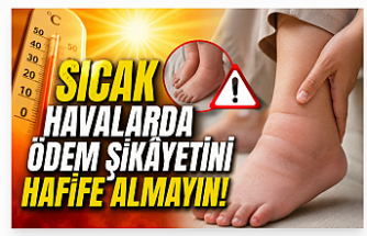 Sıcak Havalarda Ödem Şikâyetini Hafife Almayın!
