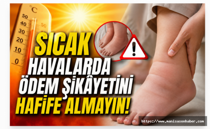 Sıcak Havalarda Ödem Şikâyetini Hafife Almayın!